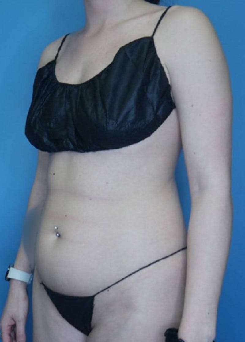 Vaser Liposuction Before & After Gallery - Patient 168926812 - Image 3