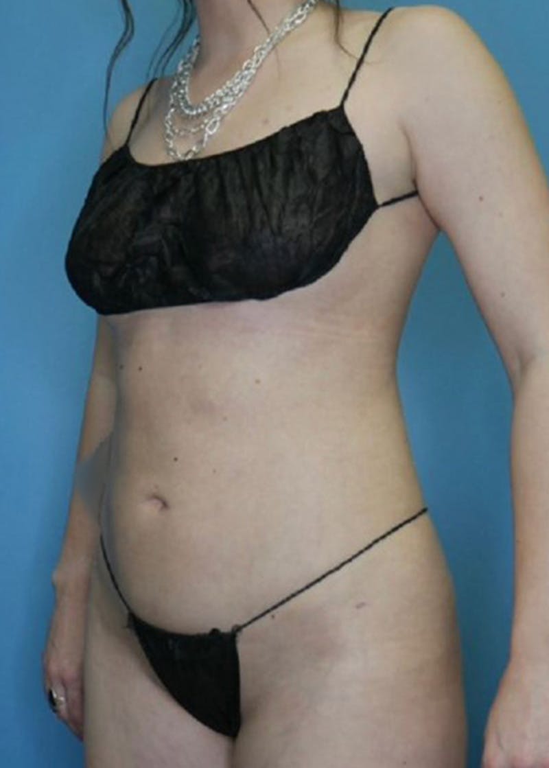 Vaser Liposuction Before & After Gallery - Patient 168926812 - Image 4