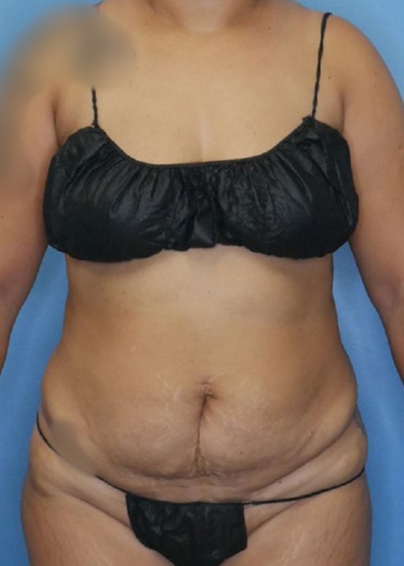 Vaser Liposuction Before & After Gallery - Patient 168932108 - Image 1