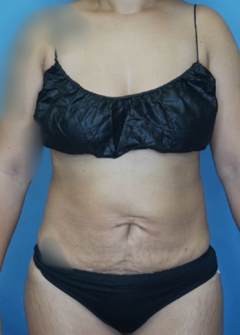 Vaser Liposuction Before & After Gallery - Patient 168932108 - Image 2