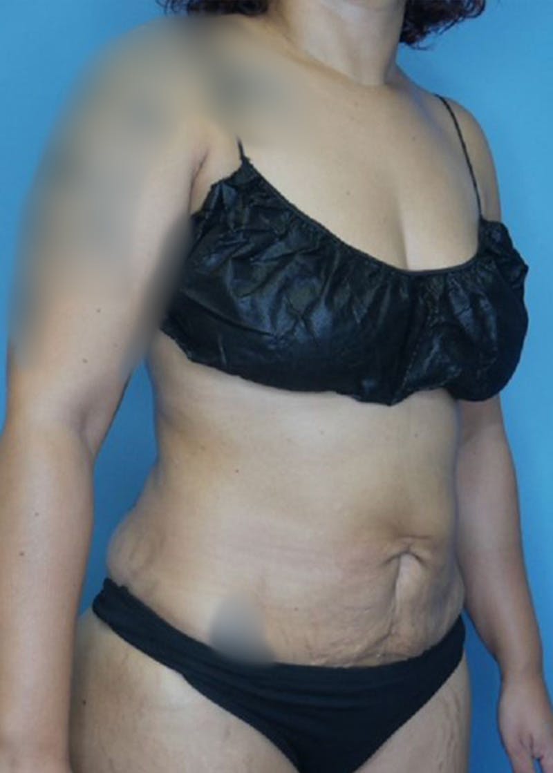 Vaser Liposuction Before & After Gallery - Patient 168932108 - Image 4
