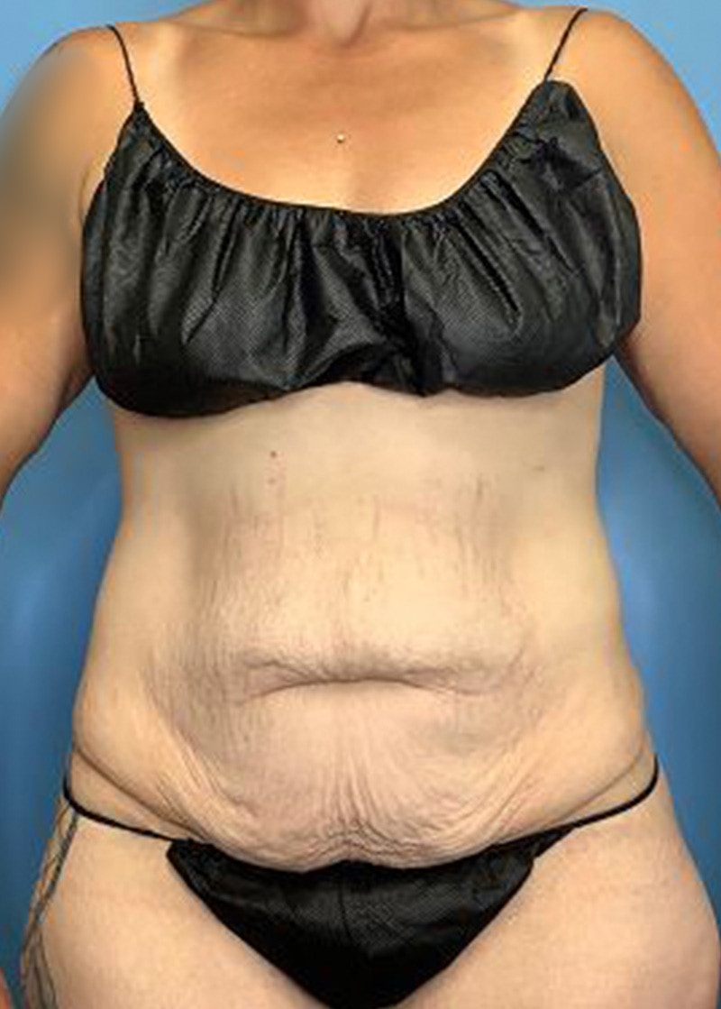 Tummy Tuck (Abdominoplasty)  Before & After Gallery - Patient 168934161 - Image 1