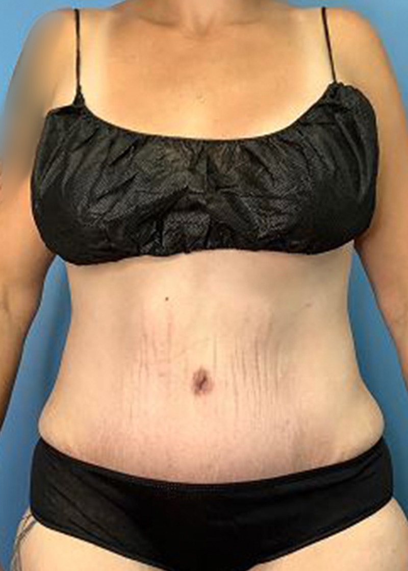 Tummy Tuck (Abdominoplasty)  Before & After Gallery - Patient 168934161 - Image 2