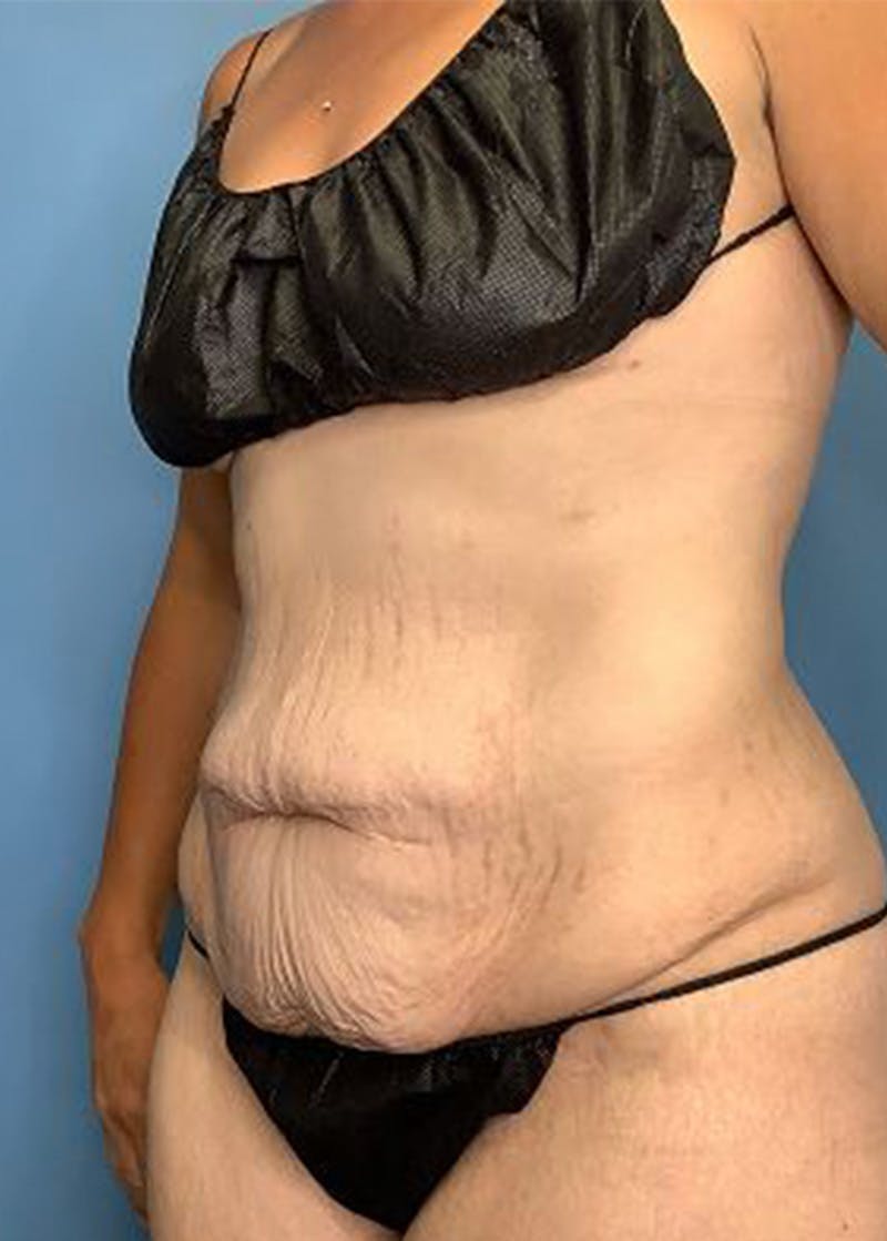 Tummy Tuck (Abdominoplasty)  Before & After Gallery - Patient 168934161 - Image 3