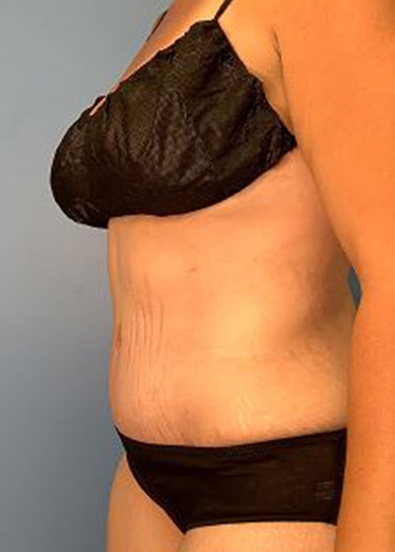 Tummy Tuck (Abdominoplasty)  Before & After Gallery - Patient 168934161 - Image 4