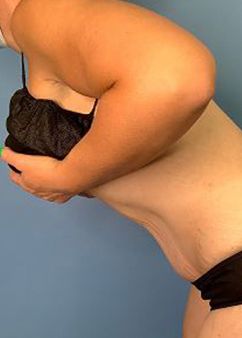 Tummy Tuck (Abdominoplasty)  Before & After Gallery - Patient 168934161 - Image 6