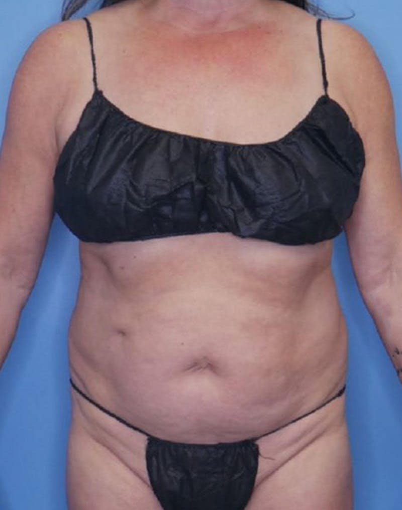 Tummy Tuck (Abdominoplasty)  Before & After Gallery - Patient 169878332 - Image 1