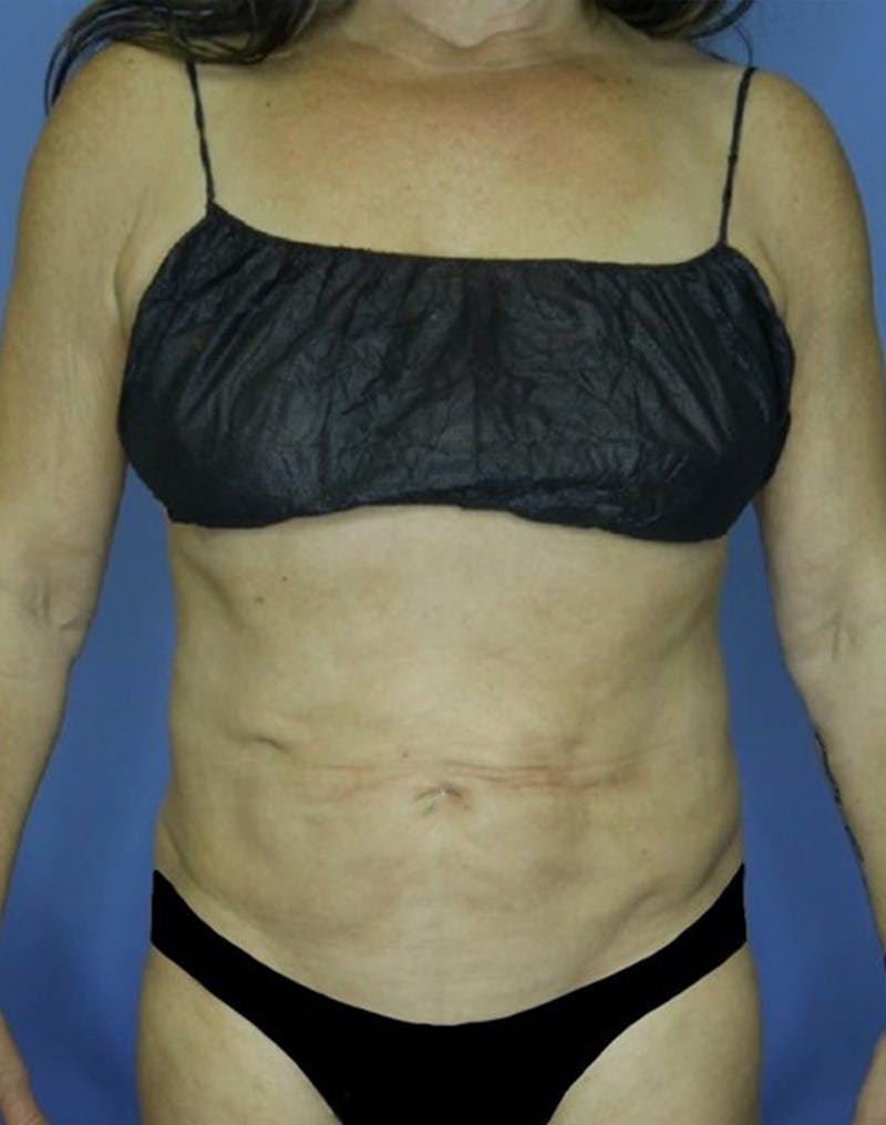 Tummy Tuck (Abdominoplasty)  Before & After Gallery - Patient 169878332 - Image 2