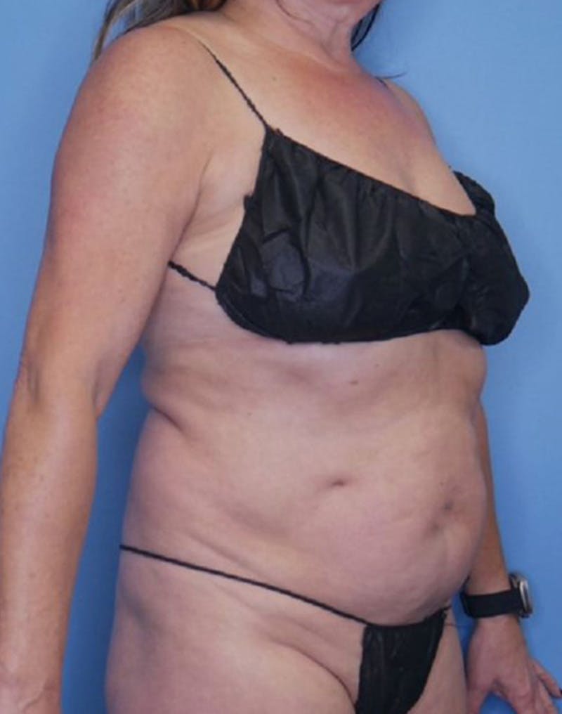 Tummy Tuck (Abdominoplasty)  Before & After Gallery - Patient 169878332 - Image 3