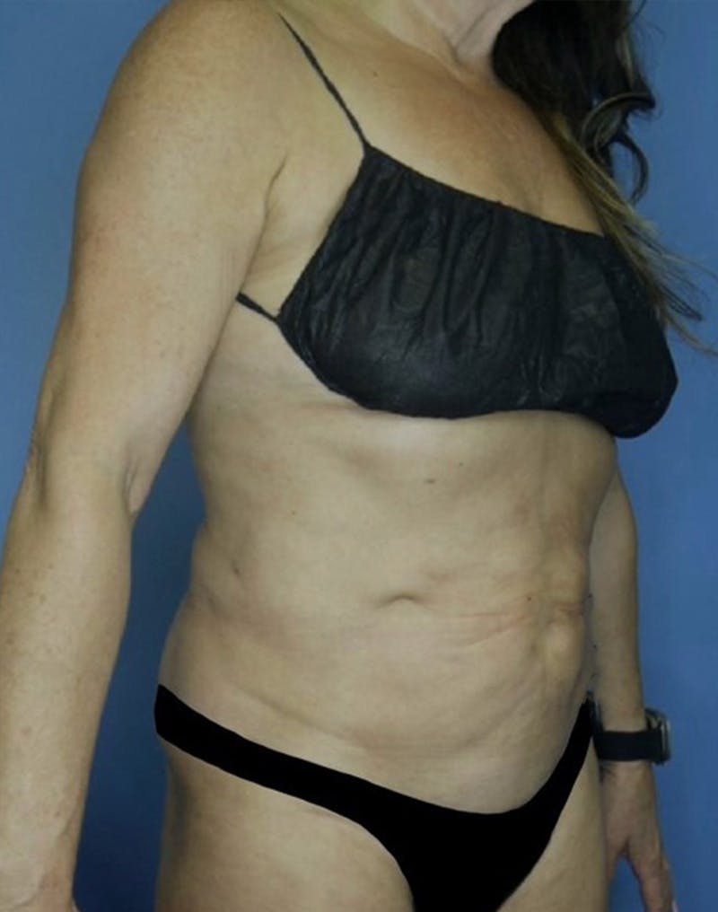 Tummy Tuck (Abdominoplasty)  Before & After Gallery - Patient 169878332 - Image 4