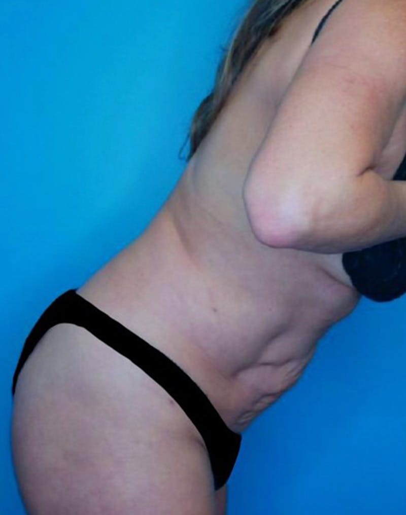 Tummy Tuck (Abdominoplasty)  Before & After Gallery - Patient 169878332 - Image 6