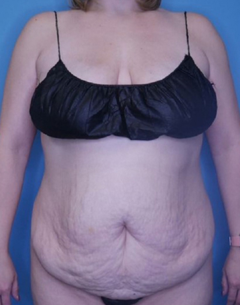 Tummy Tuck (Abdominoplasty)  Before & After Gallery - Patient 169878366 - Image 1