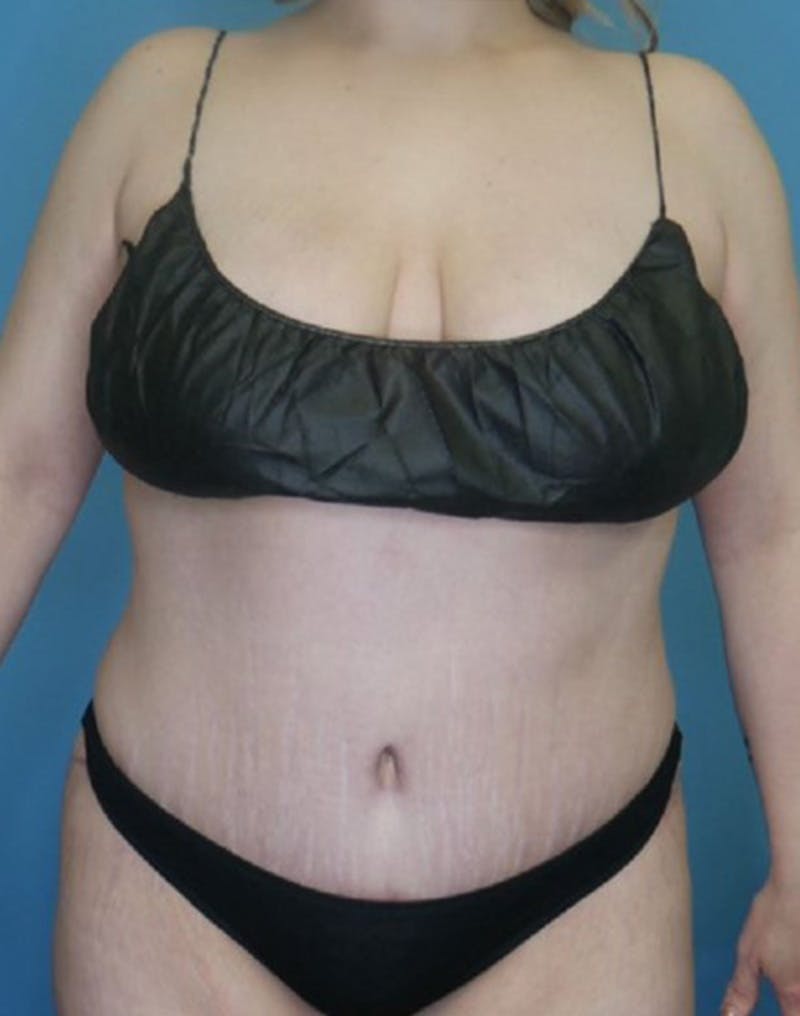 Tummy Tuck (Abdominoplasty)  Before & After Gallery - Patient 169878366 - Image 2