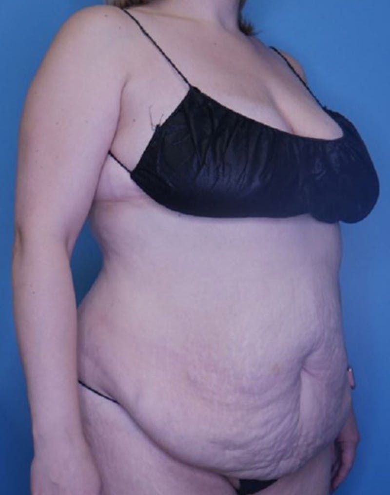 Tummy Tuck (Abdominoplasty)  Before & After Gallery - Patient 169878366 - Image 3