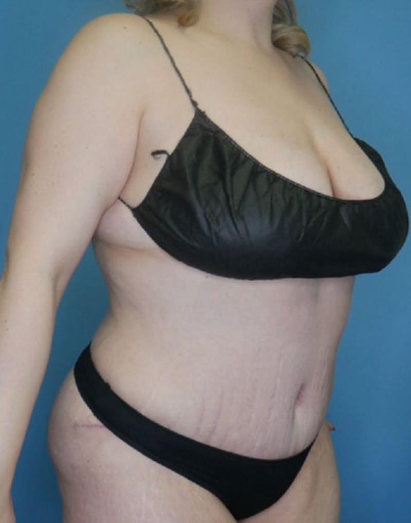 Tummy Tuck (Abdominoplasty)  Before & After Gallery - Patient 169878366 - Image 4