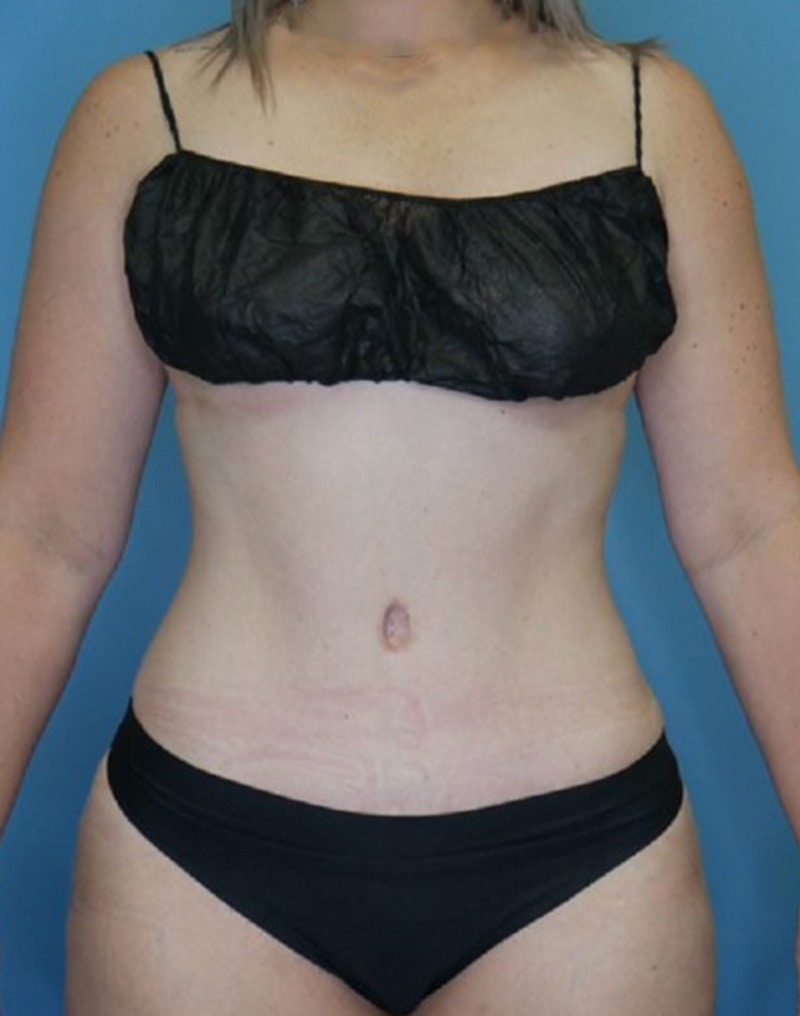 Tummy Tuck (Abdominoplasty)  Before & After Gallery - Patient 169878403 - Image 2