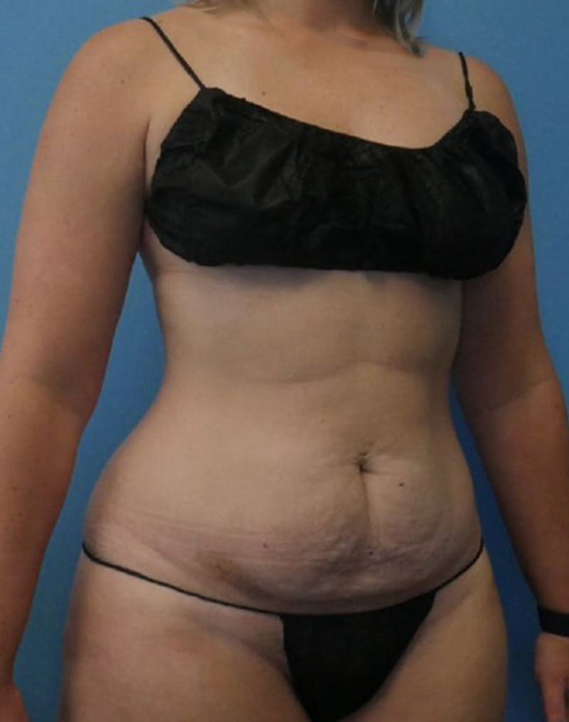 Tummy Tuck (Abdominoplasty)  Before & After Gallery - Patient 169878403 - Image 3