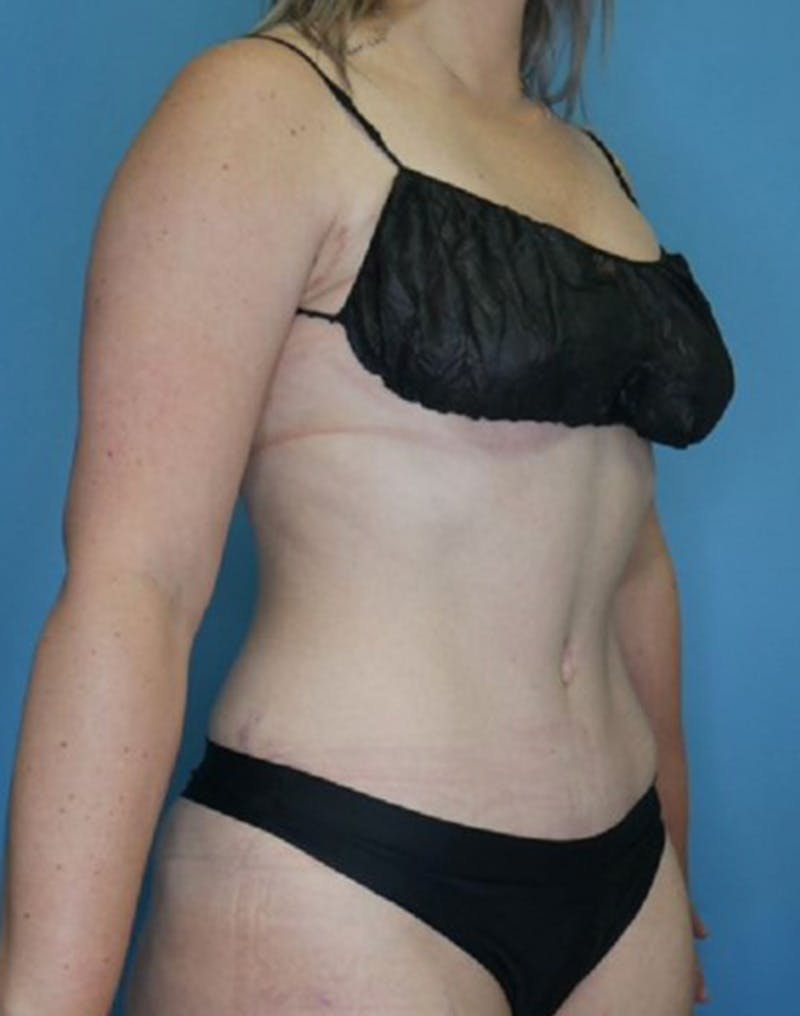 Tummy Tuck (Abdominoplasty)  Before & After Gallery - Patient 169878403 - Image 4