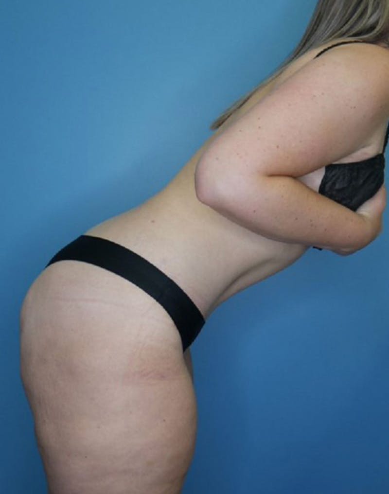 Tummy Tuck (Abdominoplasty)  Before & After Gallery - Patient 169878403 - Image 6