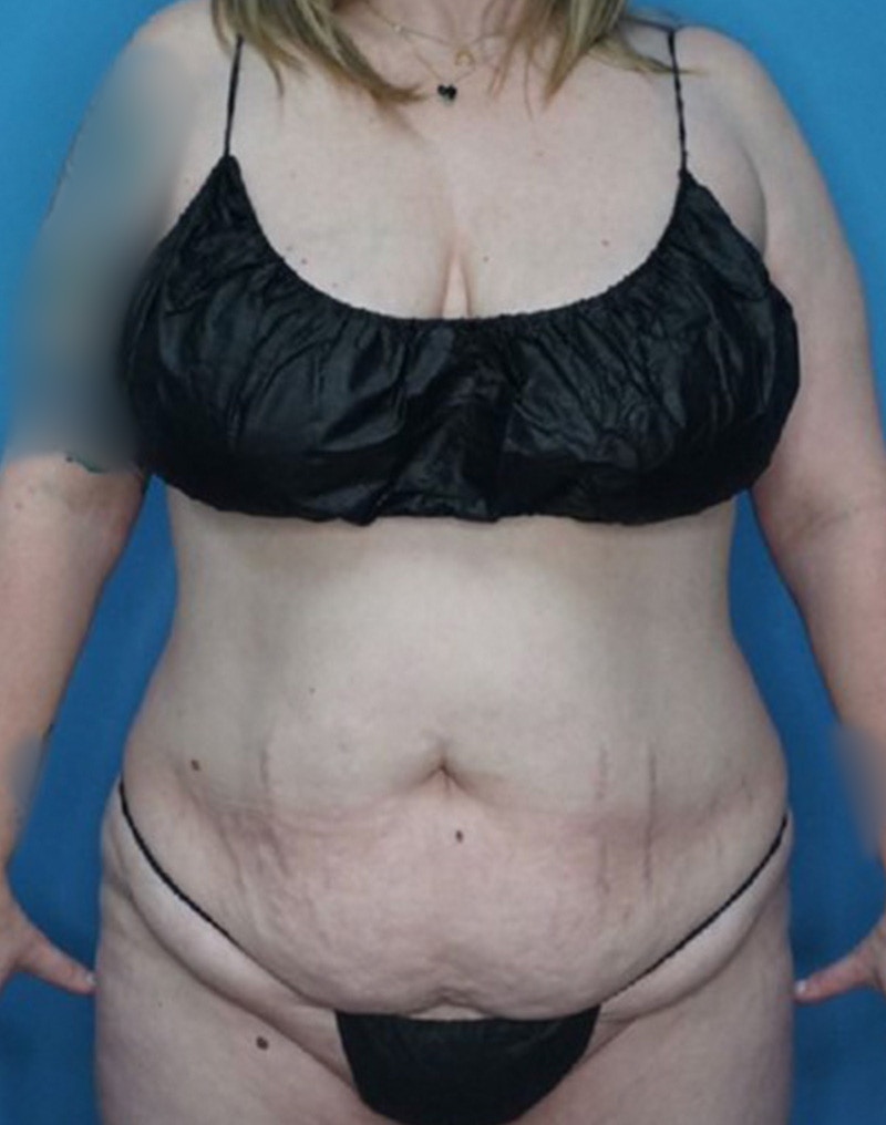 Tummy Tuck (Abdominoplasty)  Before & After Gallery - Patient 169878453 - Image 1