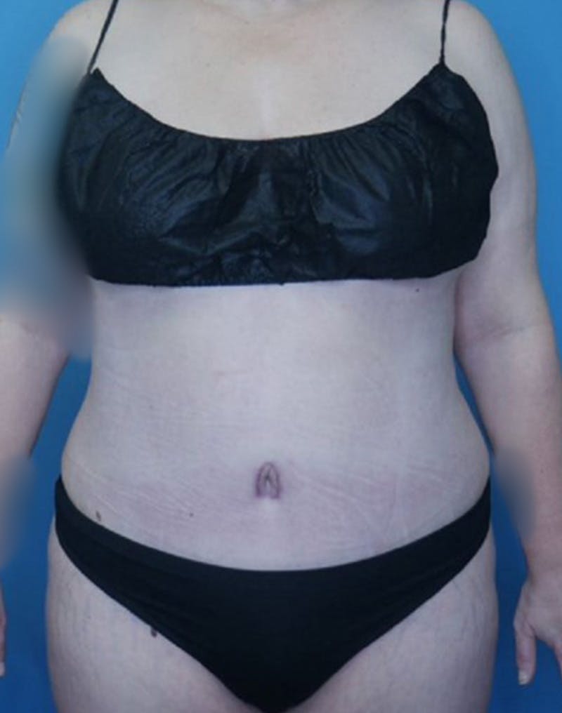 Tummy Tuck (Abdominoplasty)  Before & After Gallery - Patient 169878453 - Image 2