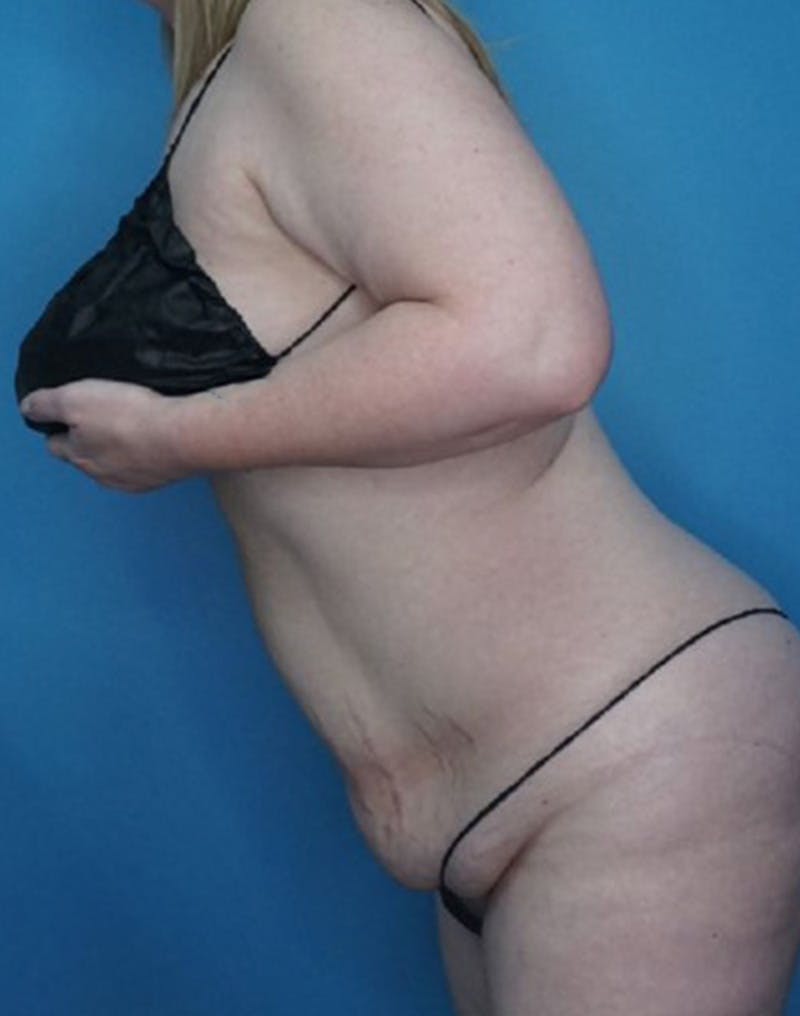 Tummy Tuck (Abdominoplasty)  Before & After Gallery - Patient 169878453 - Image 5