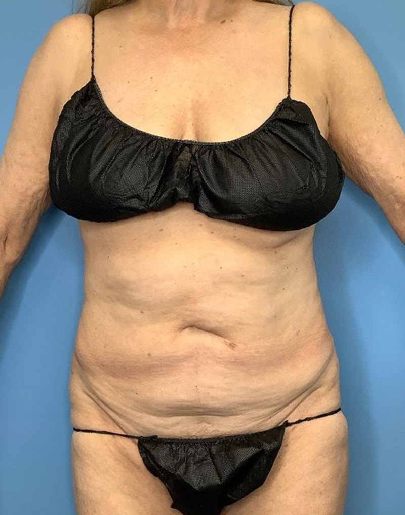 Tummy Tuck (Abdominoplasty)  Before & After Gallery - Patient 169878484 - Image 1
