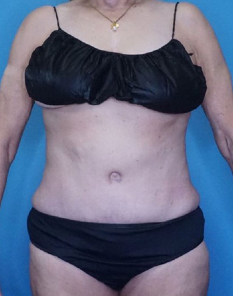 Tummy Tuck (Abdominoplasty)  Before & After Gallery - Patient 169878484 - Image 2