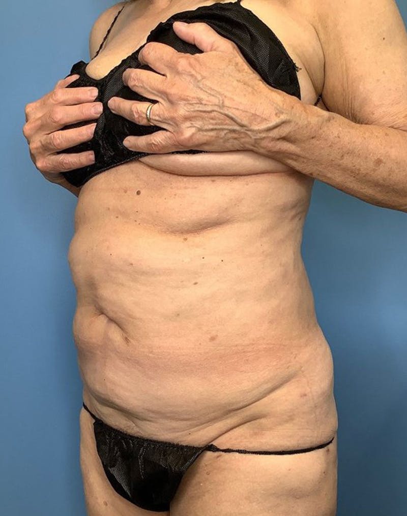 Tummy Tuck (Abdominoplasty)  Before & After Gallery - Patient 169878484 - Image 3