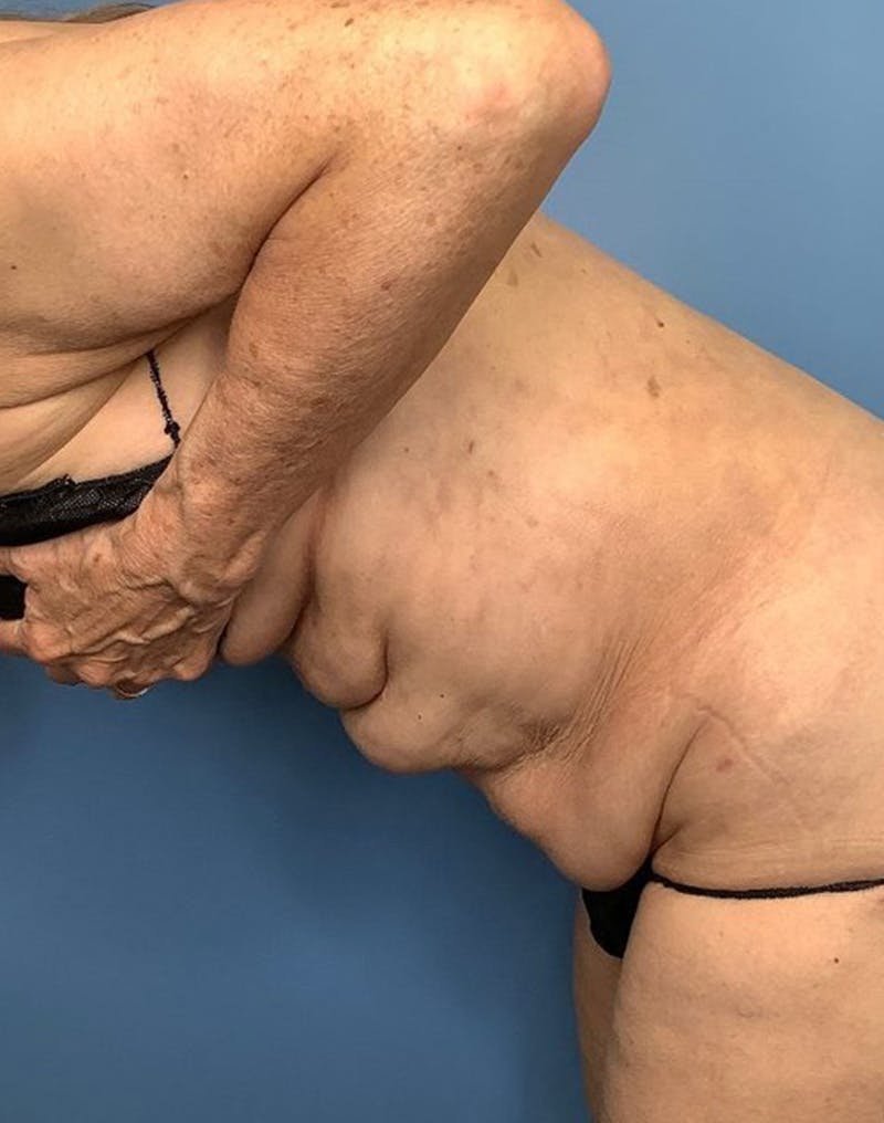 Tummy Tuck (Abdominoplasty)  Before & After Gallery - Patient 169878484 - Image 5