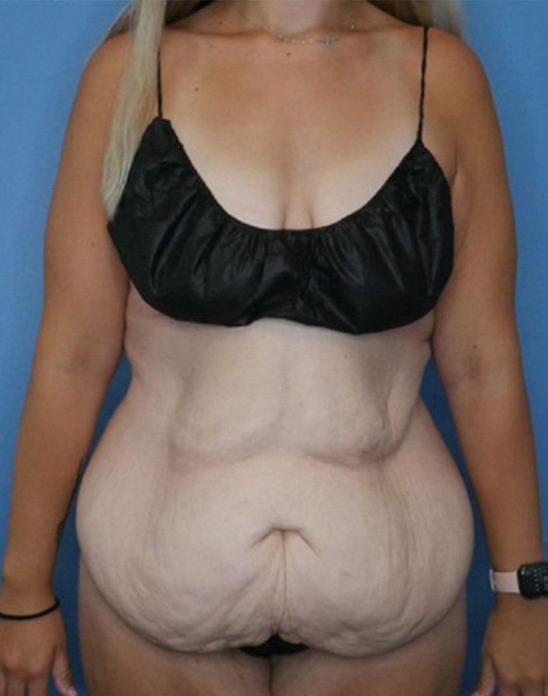 Tummy Tuck (Abdominoplasty)  Before & After Gallery - Patient 170182781 - Image 1