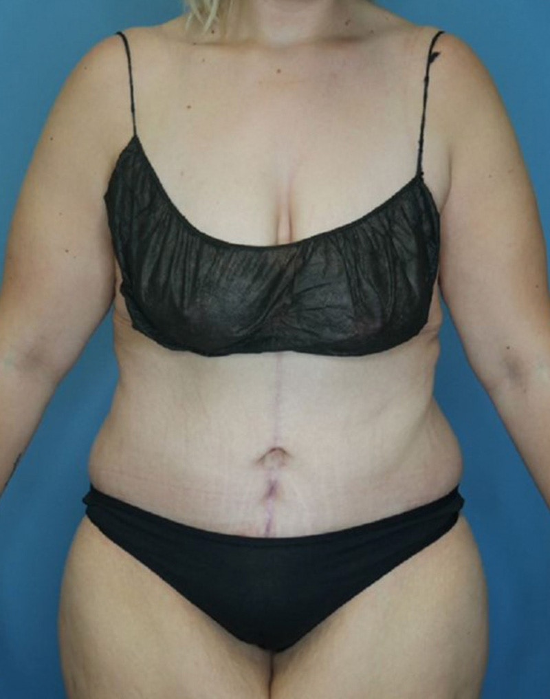 Tummy Tuck (Abdominoplasty)  Before & After Gallery - Patient 170182781 - Image 2