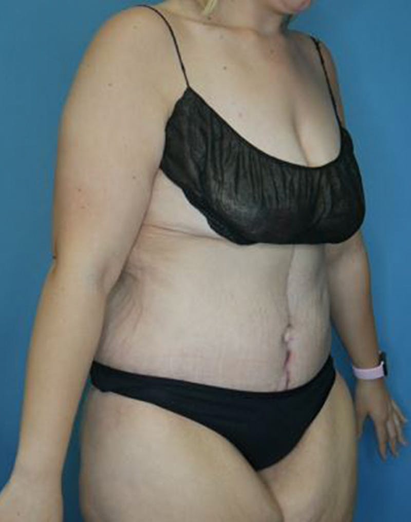 Tummy Tuck (Abdominoplasty)  Before & After Gallery - Patient 170182781 - Image 4