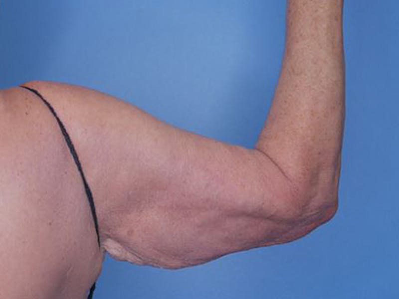 Arm Lift (Brachioplasty)  Before & After Gallery - Patient 170182988 - Image 1