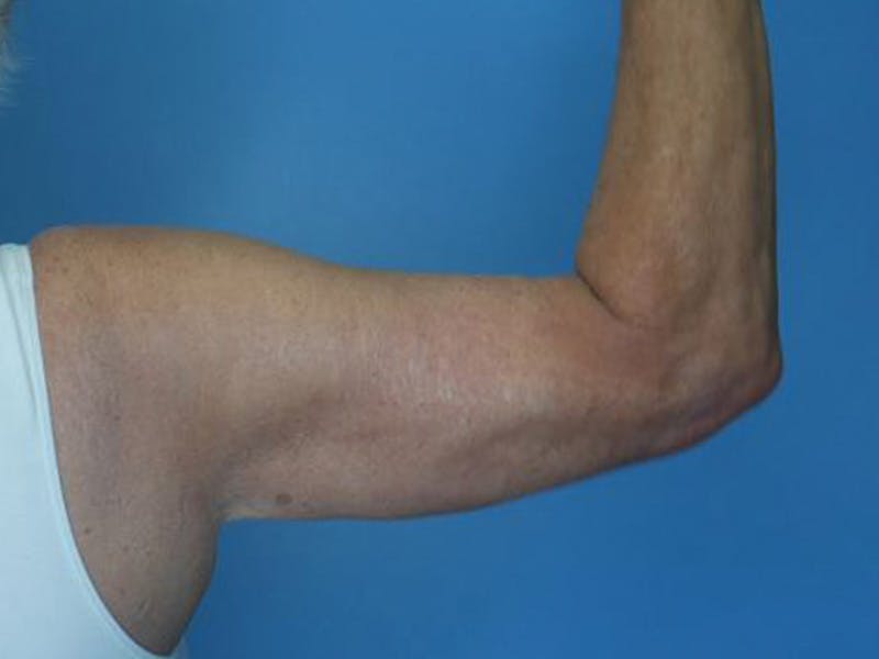 Arm Lift (Brachioplasty)  Before & After Gallery - Patient 170182988 - Image 2