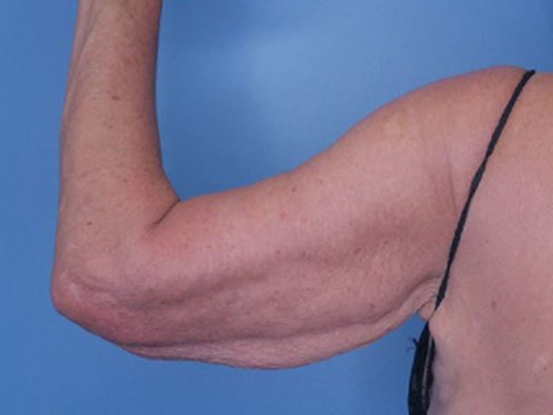 Arm Lift (Brachioplasty)  Before & After Gallery - Patient 170182988 - Image 3