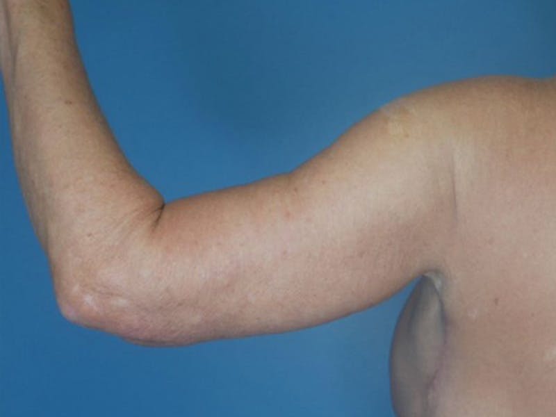 Arm Lift (Brachioplasty)  Before & After Gallery - Patient 170182988 - Image 4