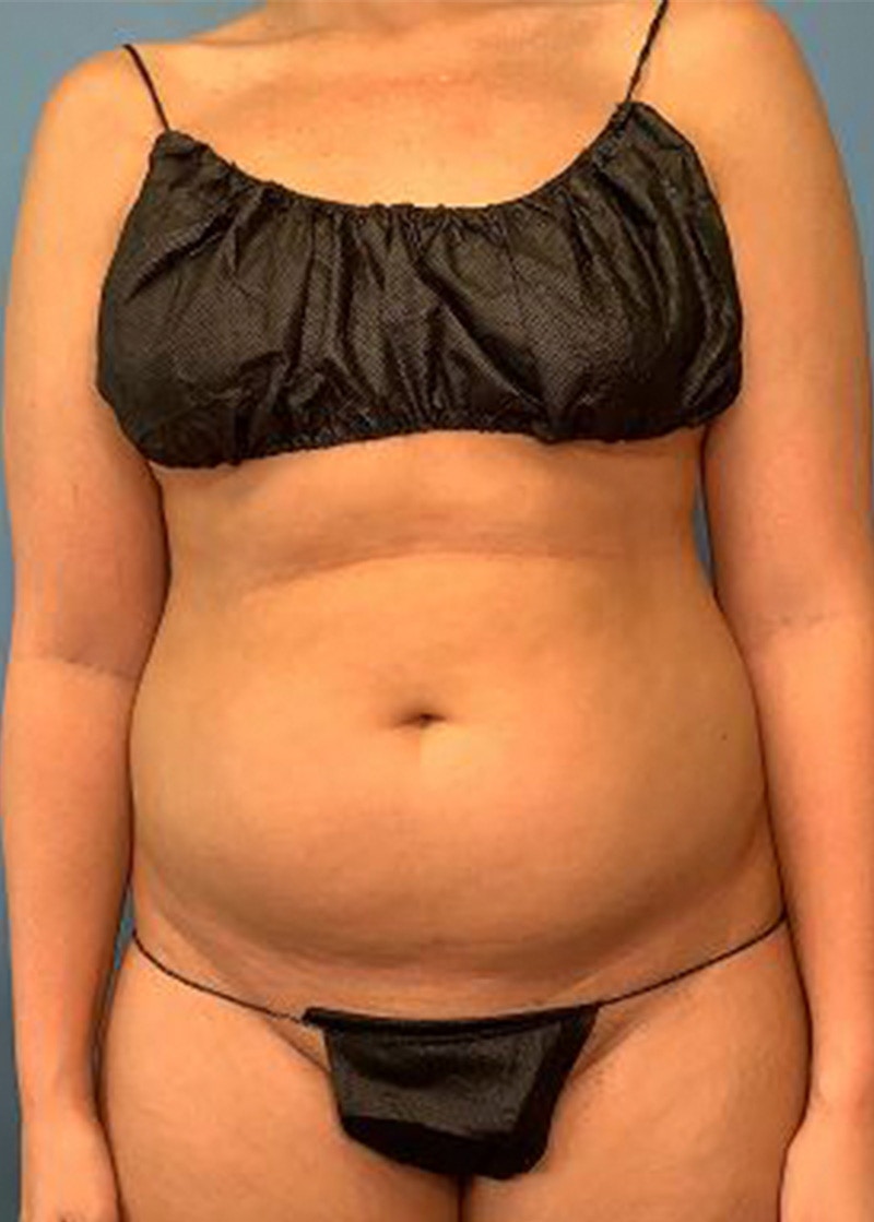 Vaser Liposuction Before & After Gallery - Patient 170194444 - Image 1