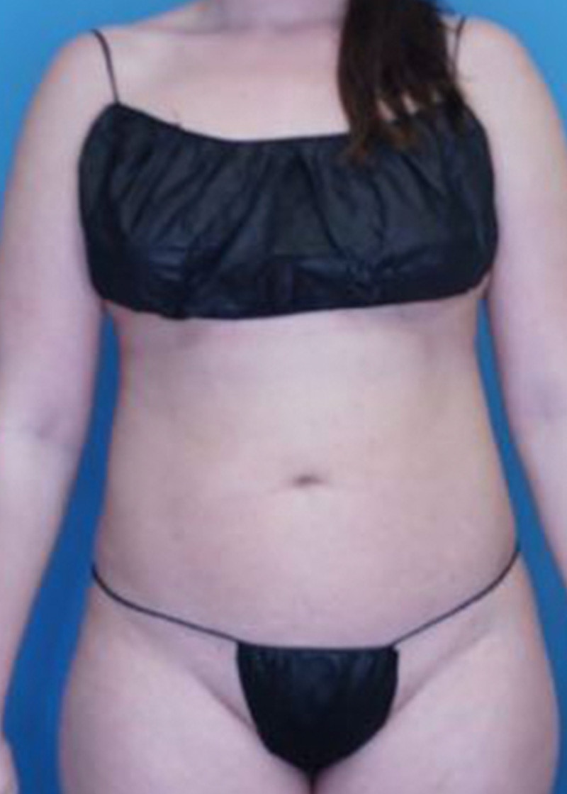 Vaser Liposuction Before & After Gallery - Patient 170194444 - Image 2