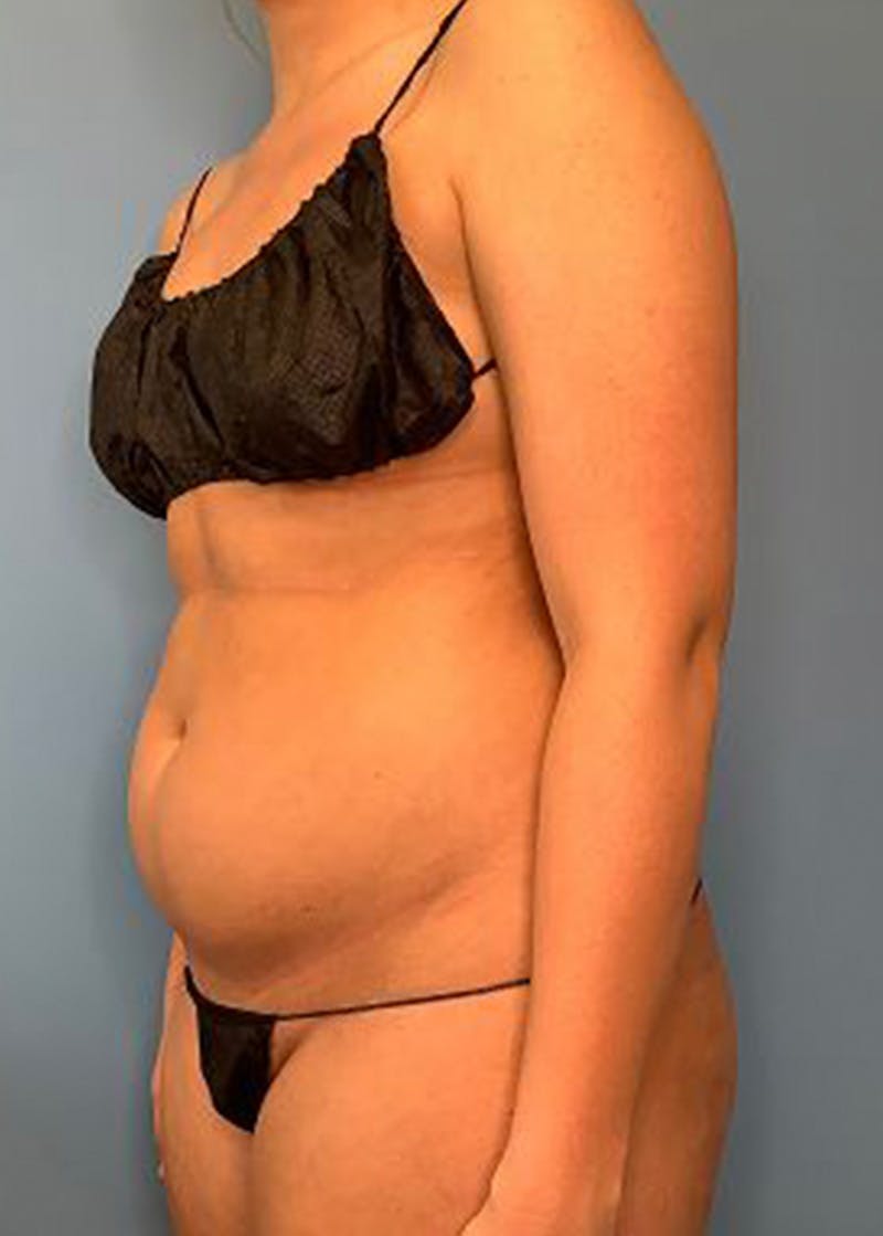Vaser Liposuction Before & After Gallery - Patient 170194444 - Image 3