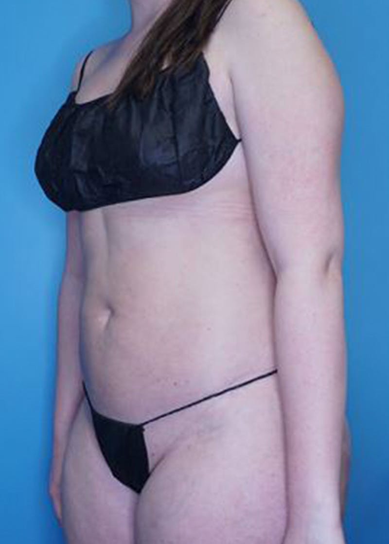 Vaser Liposuction Before & After Gallery - Patient 170194444 - Image 4