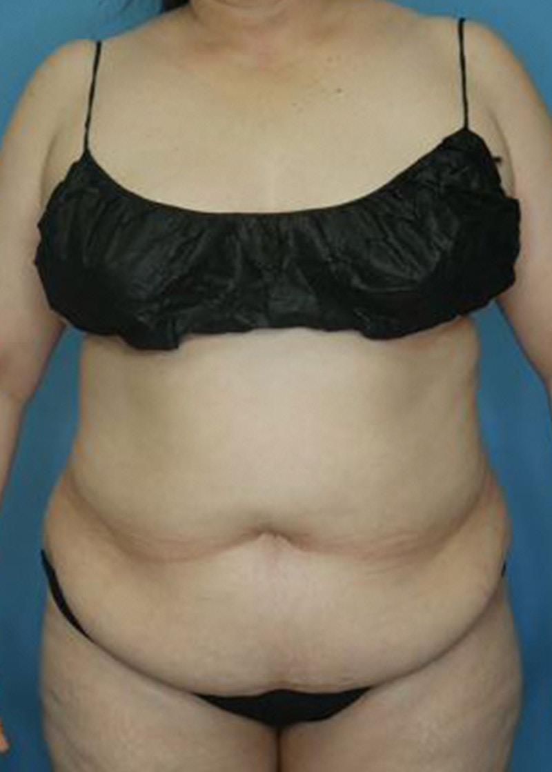 Mini Tummy Tuck Before & After Gallery - Patient 168909829 - Image 1