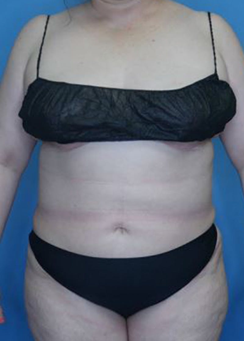 Vaser Liposuction Before & After Gallery - Patient 168909826 - Image 2