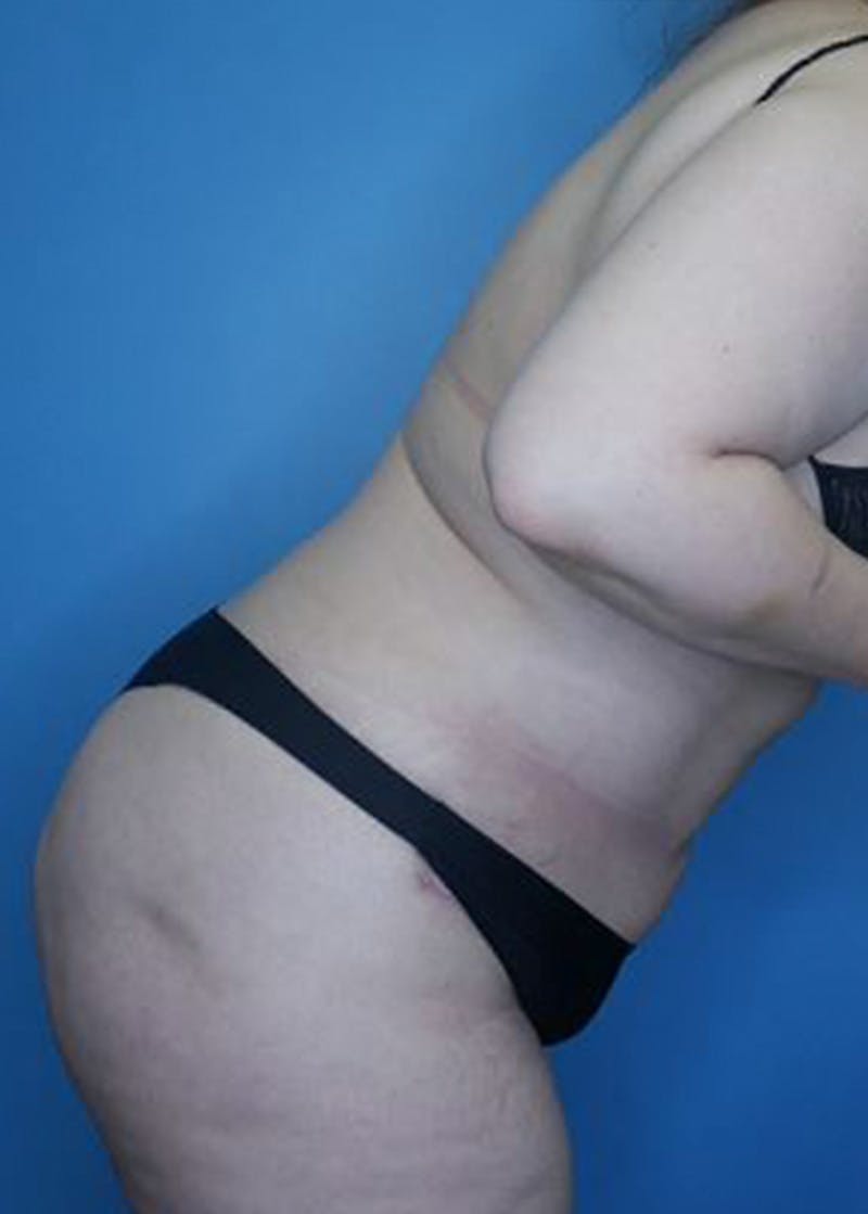 Mini Tummy Tuck Before & After Gallery - Patient 168909829 - Image 6