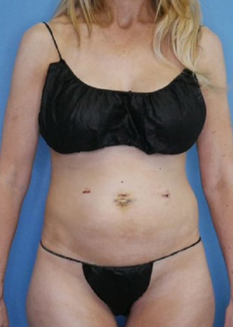 Vaser Liposuction Before & After Gallery - Patient 170647020 - Image 1