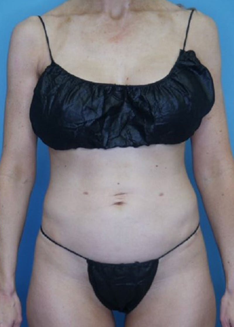 Vaser Liposuction Before & After Gallery - Patient 170647020 - Image 2