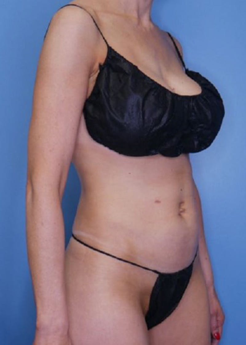 Vaser Liposuction Before & After Gallery - Patient 170647020 - Image 3