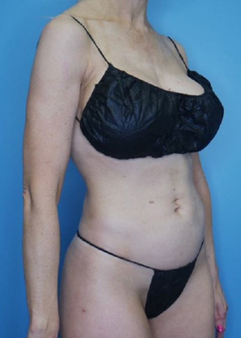 Vaser Liposuction Before & After Gallery - Patient 170647020 - Image 4