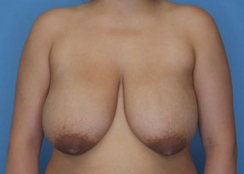Breast Reduction Before & After Gallery - Patient 170650137 - Image 1
