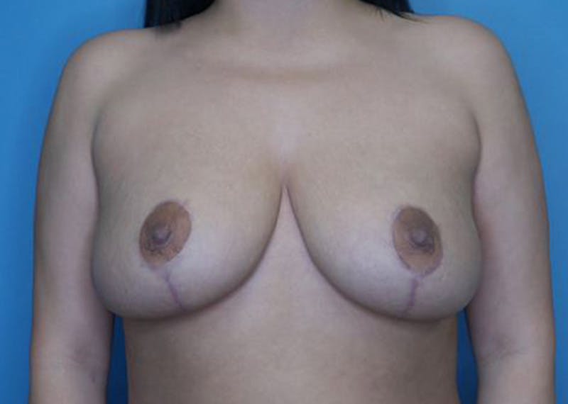 Breast Reduction Before & After Gallery - Patient 170650137 - Image 2